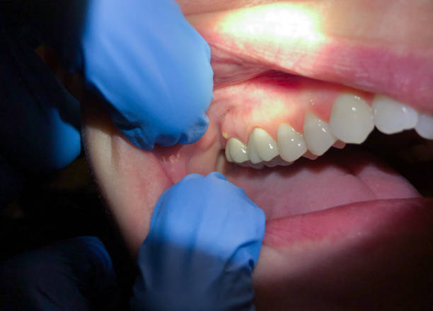 Best Emergency Tooth Extraction in Harristown, IL